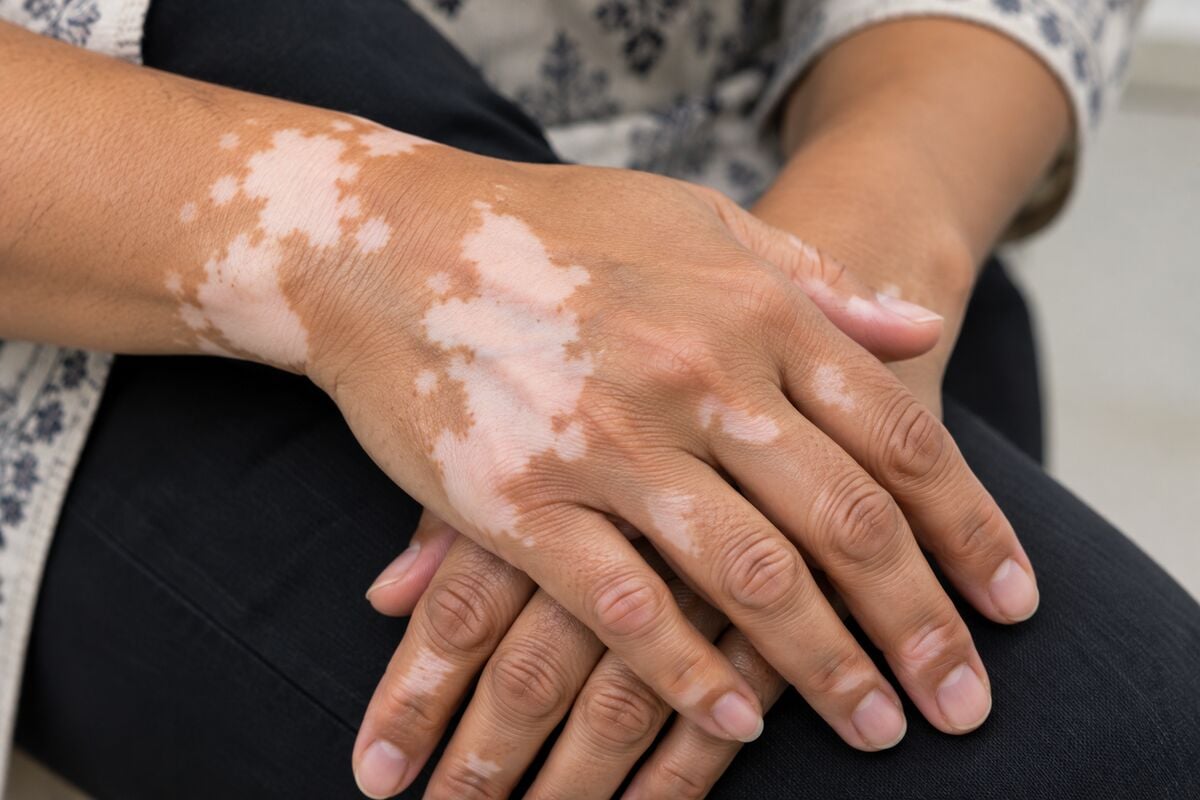 Vitiligo on the hand